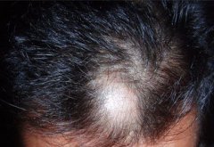 植发可以治疗物理性脱发吗