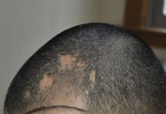 疤痕植发需要多少钱