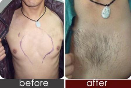 胸毛种植的效果如何？